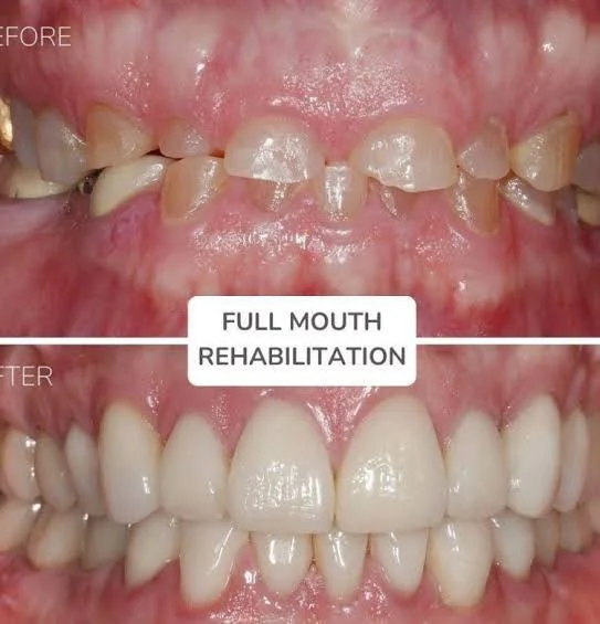 ฟื้นฟูช่องปากทั้งปาก Full Mouth Rehab DC Dental