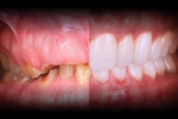 ฟื้นฟูช่องปากทั้งปาก Full Mouth Rehab DC Dental