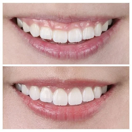 ตัดแต่งเหงือก (Gum Contouring)