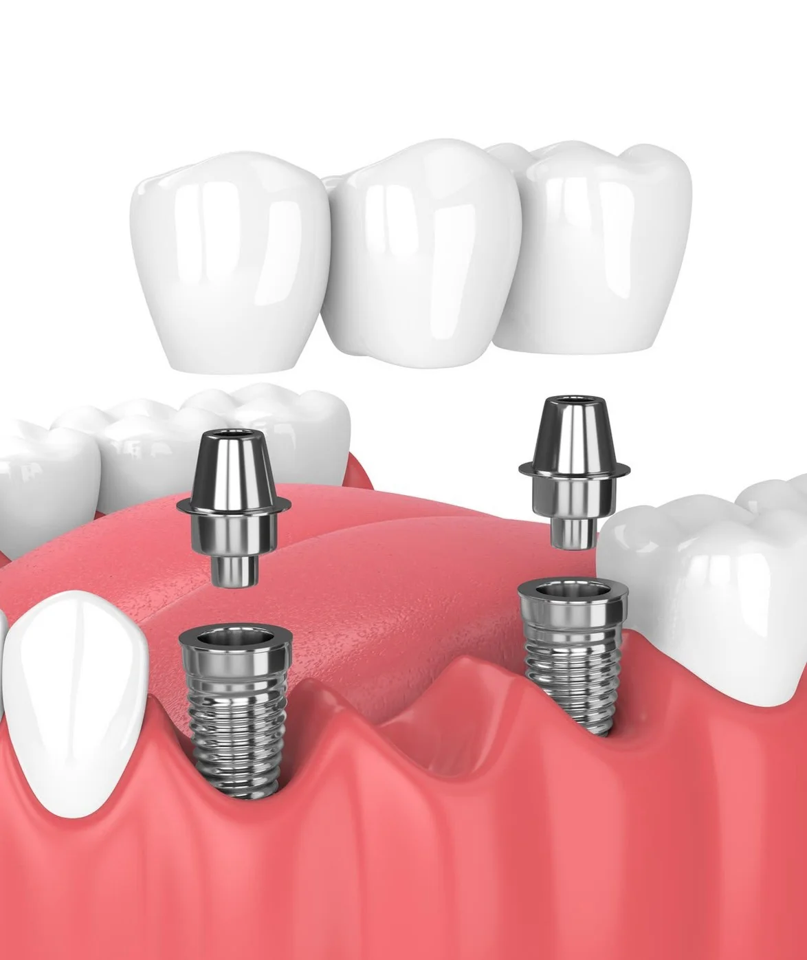 รากฟันเทียม ดิจิทัล DC Dental