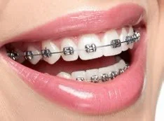 จัดฟันโลหะ (Metal Braces)
