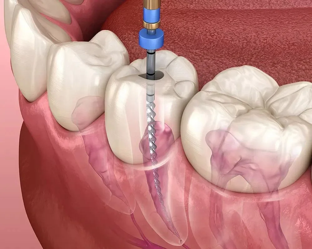รักษารากฟัน (Root Canal Treatment)