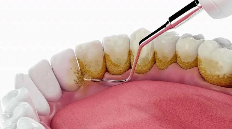 ขูดหินปูน & ขัดฟัน (Dental Scaling)