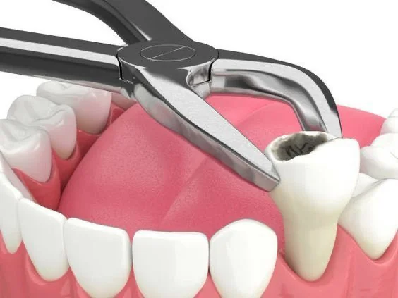 ถอนฟัน (Tooth Extraction)