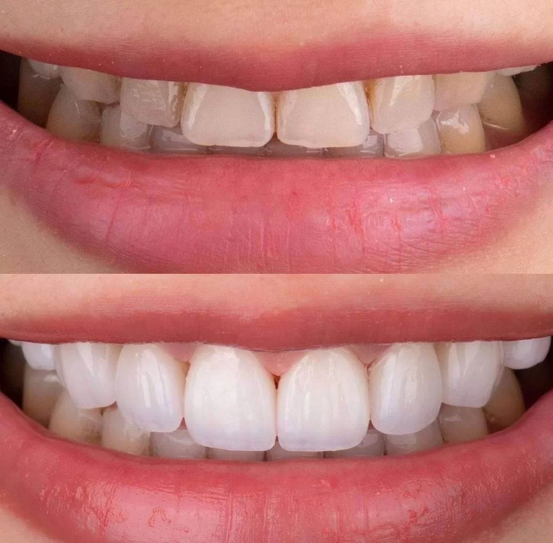 เคลือบฟันเทียม วีเนียร์ DC Dental