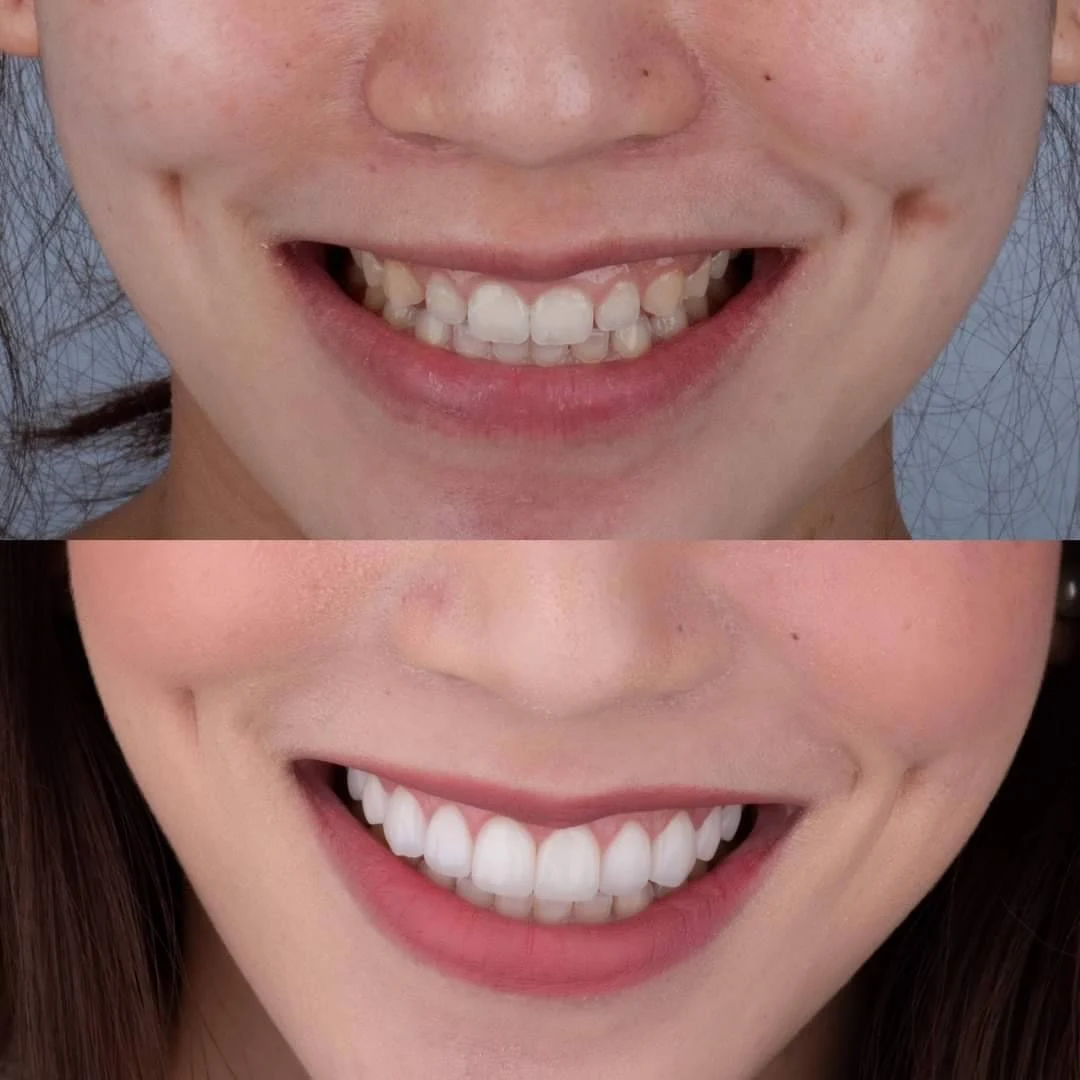เคลือบฟันเทียม วีเนียร์ DC Dental