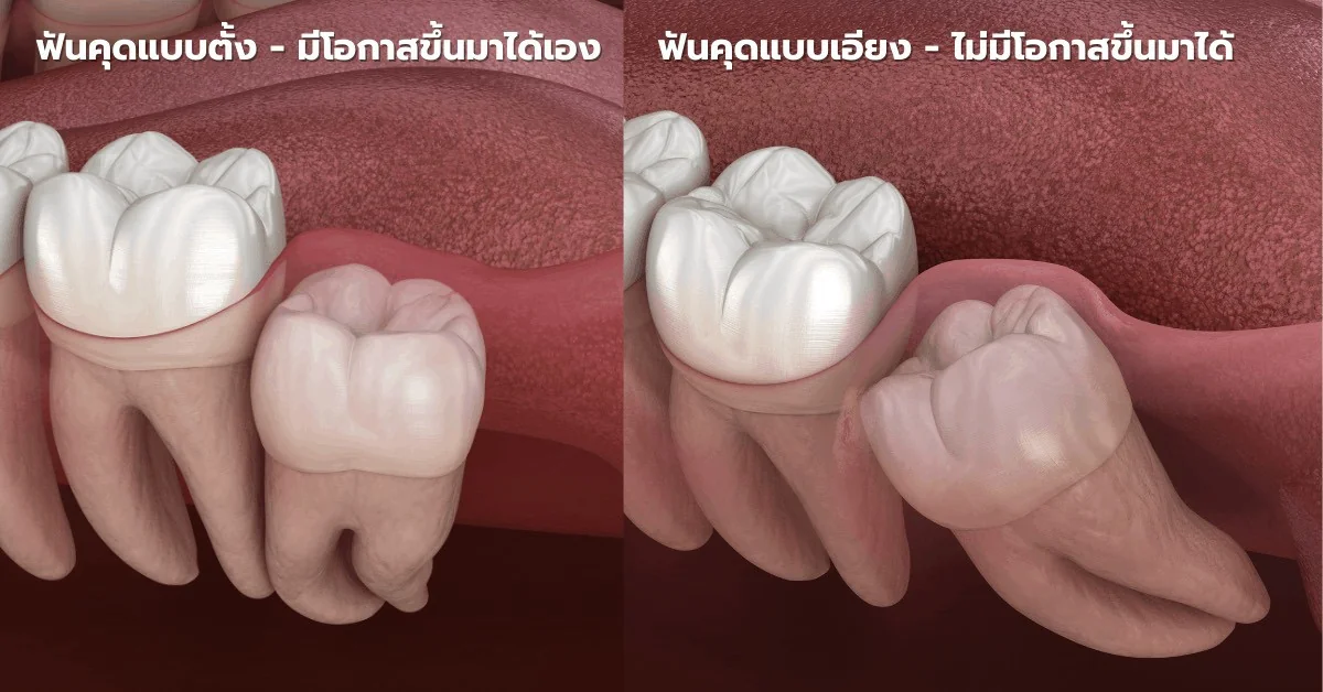 ผ่าฟันคุด & ถอนฟันคุด (Wisdom Teeth)
